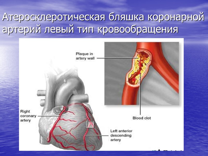 Атеросклеротическая бляшка коронарной артерий левый тип кровообращения